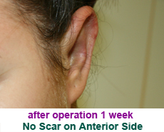 plastic-surgery-prominent-ear 